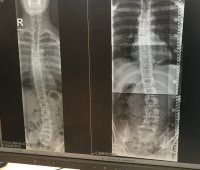 before and after spine.png