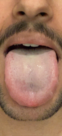 dry_tongue.PNG
