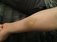 bruise.JPG