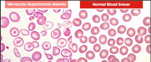sideroblastic anemia.png